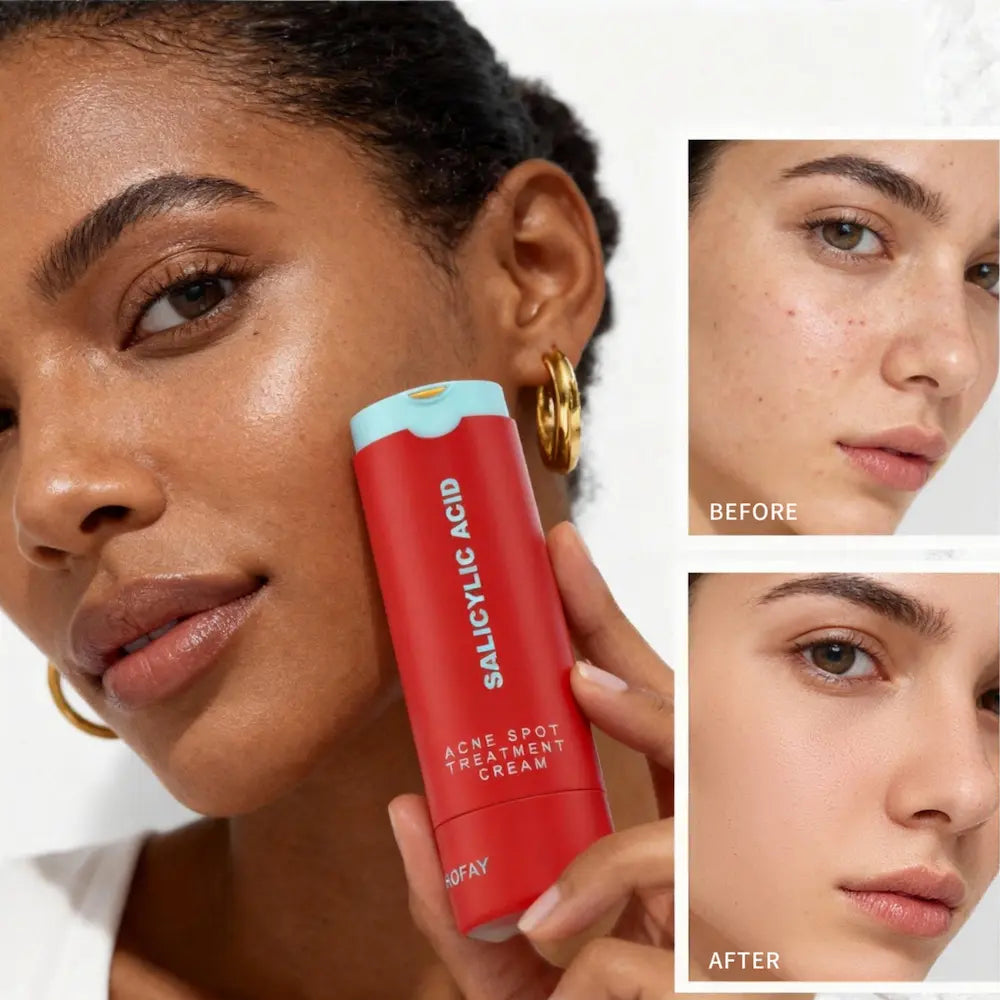 Woman holding a red Salicylic Acid acne spot treatment cream with 'Before' and 'After' skin comparisons.